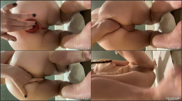 Huge Teen Anal Prolapse